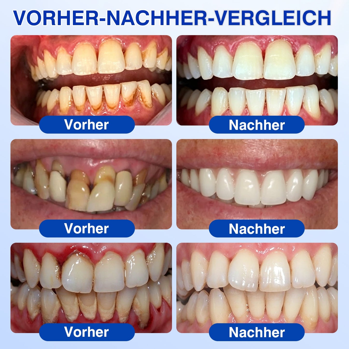 🇩🇪🏅🦷🛡️𝐋𝐮𝐱𝐚𝐫𝐢𝐬𝐞® GumRevive Parodontal-Reparaturgel