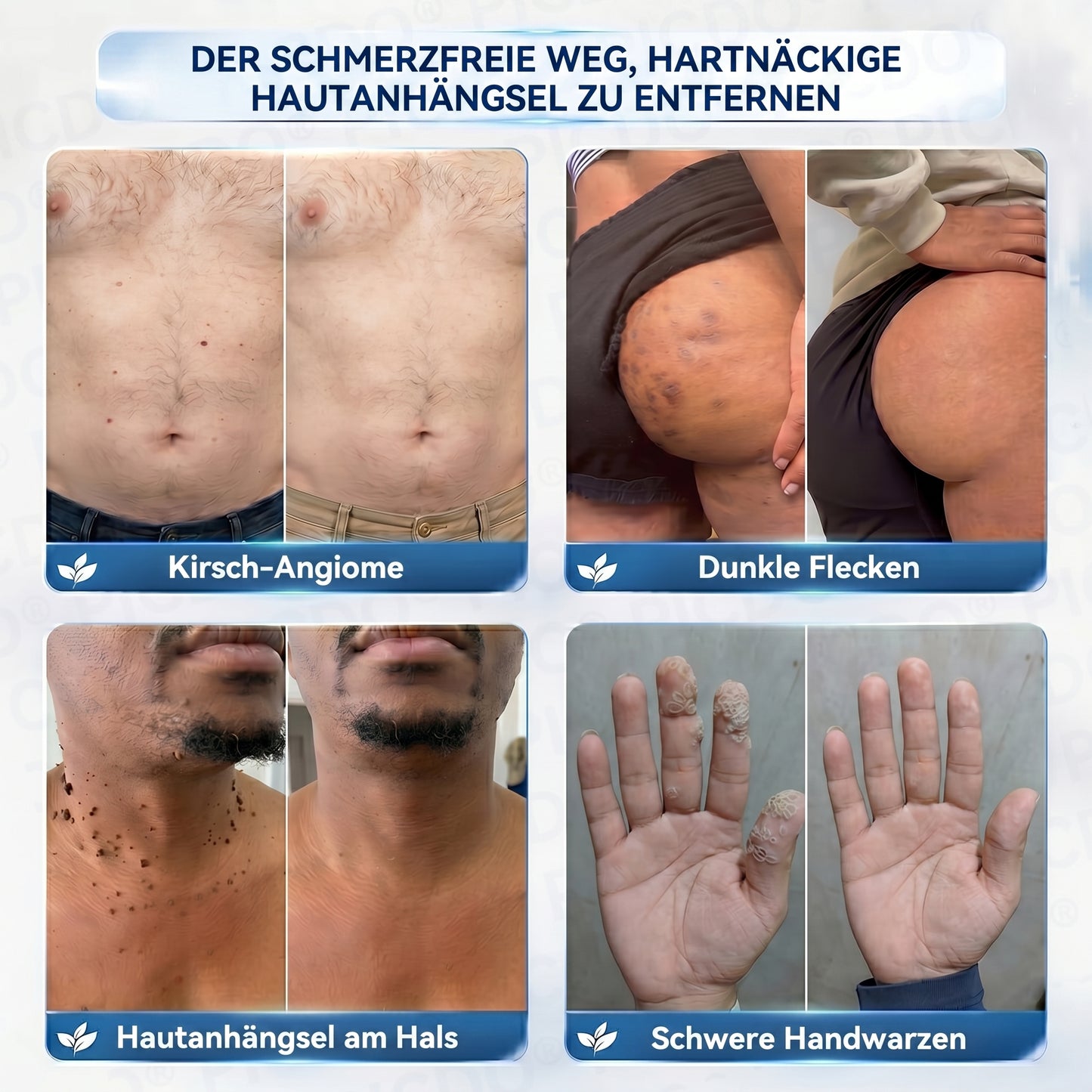 𝐏𝐢𝐜𝐝𝐨® 𝟕-𝐓𝐚𝐠𝐞 𝐇𝐚𝐮𝐭𝐚𝐧𝐡ä𝐧𝐠𝐞𝐫- & 𝐅𝐥𝐞𝐜𝐤𝐞𝐧-𝐄𝐧𝐭𝐟𝐞𝐫𝐧𝐮𝐧𝐠𝐬𝐜𝐫𝐞𝐦𝐞 (𝐒𝐜𝐡𝐦𝐞𝐫𝐳𝐟𝐫𝐞𝐢 & 𝐍𝐚𝐫𝐛𝐞𝐧𝐟𝐫𝐞𝐢-𝐅𝐨𝐫𝐦𝐞𝐥) 🌹