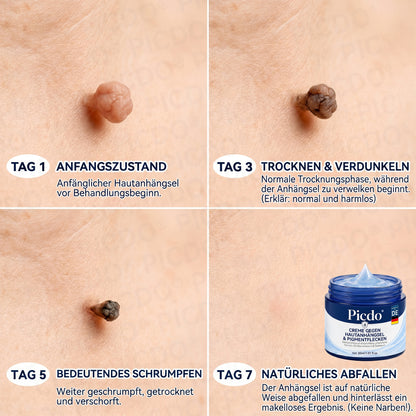 𝐏𝐢𝐜𝐝𝐨® 𝟕-𝐓𝐚𝐠𝐞 𝐇𝐚𝐮𝐭𝐚𝐧𝐡ä𝐧𝐠𝐞𝐫- & 𝐅𝐥𝐞𝐜𝐤𝐞𝐧-𝐄𝐧𝐭𝐟𝐞𝐫𝐧𝐮𝐧𝐠𝐬𝐜𝐫𝐞𝐦𝐞 (𝐒𝐜𝐡𝐦𝐞𝐫𝐳𝐟𝐫𝐞𝐢 & 𝐍𝐚𝐫𝐛𝐞𝐧𝐟𝐫𝐞𝐢-𝐅𝐨𝐫𝐦𝐞𝐥) 🌹